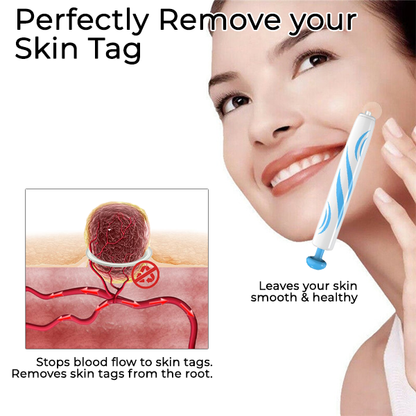 Seurico™ At-home Skin Tag Removal Pen