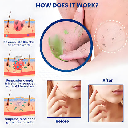✅ Official Store: Seurico™ Instant Mole & Spot Cream